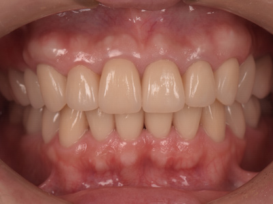 術後